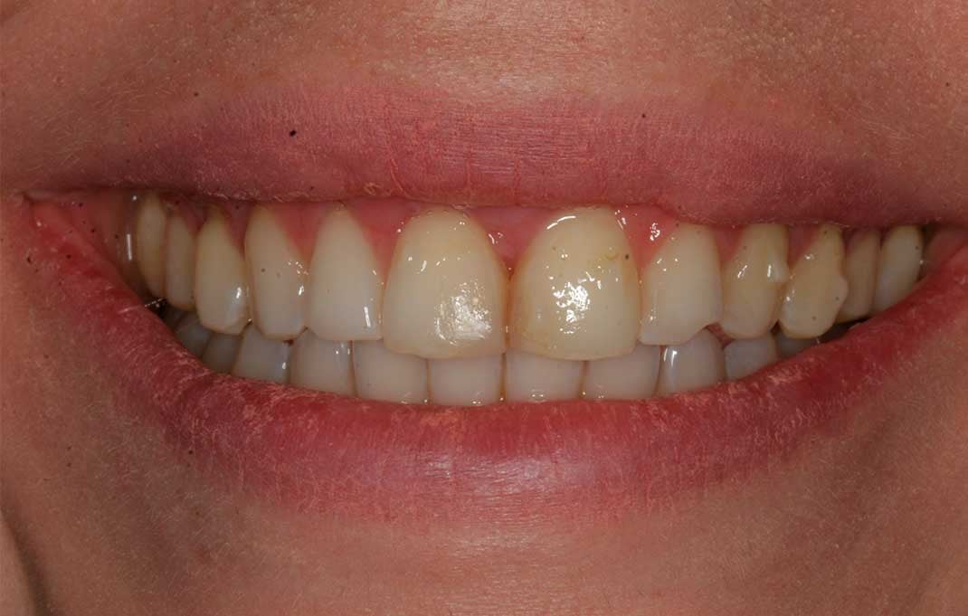 The patient's teeth and smile before having DSD veneers.