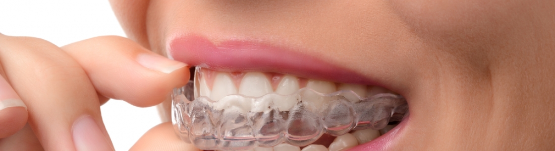 How Does Invisalign Work?