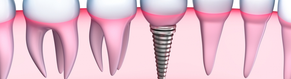 How Long Does The Dental Implant Placement Take