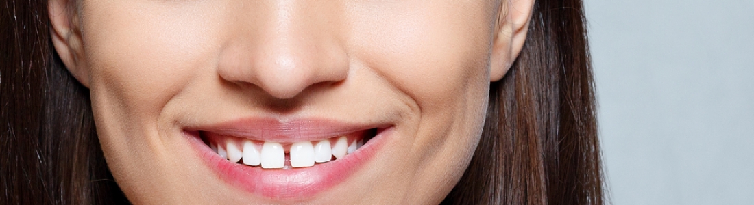 How To Fix Gaps In Teeth