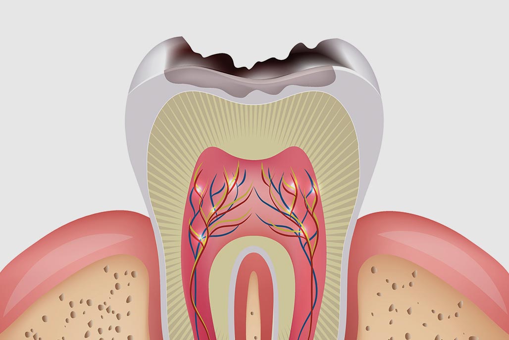 A drawing of the anatomy of a tooth showing where dental cavities can develop.
