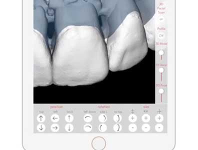 The design of a patient's teeth on the Digital Smile Design app.