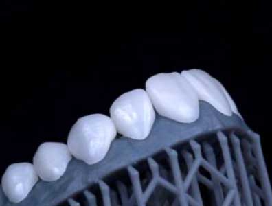 A close-up of natural-looking teeth created using Digital Smile Design.