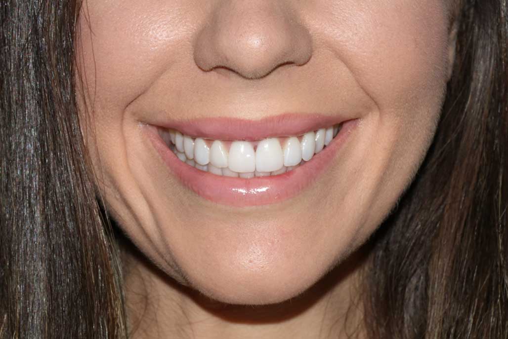 A close-up of a woman's beautiful smile created using veneers and Digital Smile Design.