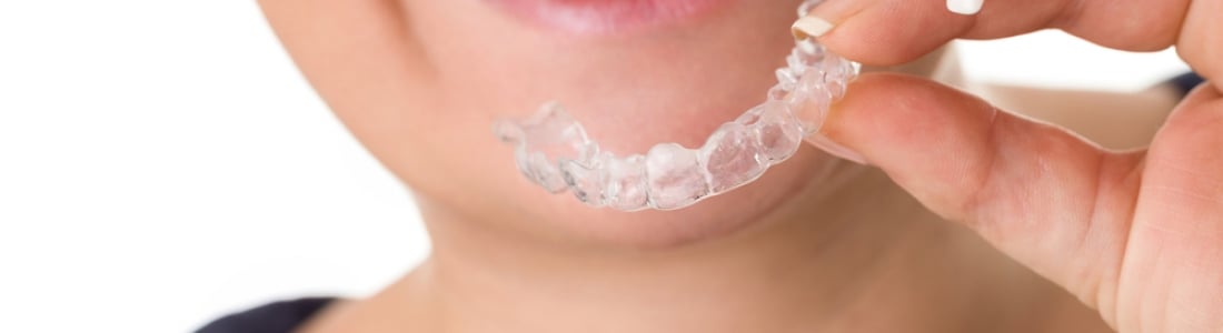 Invisalign vs. Braces