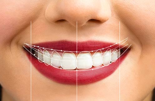 A patient's smile with line drawings showing the alterations made to suit her facial features.